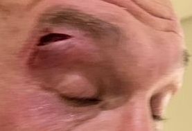 0 Tyson Furys cut suffered in sparring today that has caused the Oleksandr Usyk fight to be postponed